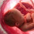 Поздний токсикоз при беременности: группа риска, как проявляется, можно ли избежать, чем лечить и какие последствия могут быть для ребенка