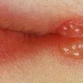 Герпес на губе во время беременности: причины появления, методы лечения Появился герпес на губе во время беременности